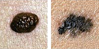 Fotografia comparando un lunar normal y melanoma enseñado borden