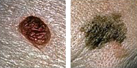 Fotografia comparando un lunar normal y melanoma enseñado diámetro
