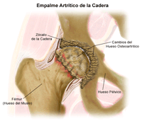Ilustración de un empalme artrítico de la cadera