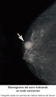 Fotografía de un mamograma indicando un nudo canceroso en el seno