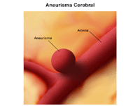 Ilustración del aneurysm cerebral