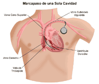 Dibujo de un marcapasos de una sola cavidad