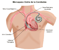 Dibujo de un marcapasos de ambas cavidades