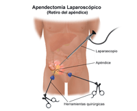 Ilustración del appendectomy laparoscopic