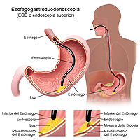 Dibujo que demuestra la esofagogastroduodenoscopia