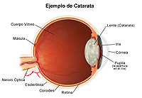 Ilustración de una catarata