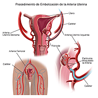 Ilustración de un procedimiento uterino del embolization de la arteria