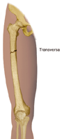 Dibujo de la fractura transversa