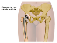 Ilustración de un ejemplo de una cadera artificial