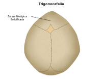 Dibujo del cráneo de un recién nacido con trigonocefalia 