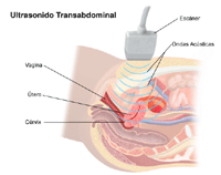 Illustration of a transabdominal ultrasound procedure