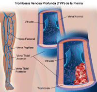 Ilustración de la trombosis profunda de la vena de la pierna