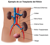 Ejemplo del trasplante del riñón