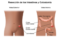 Dibujo de la resección de un intestino y de la colostomía