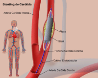 Ilustración del procedimiento de stenting de carótida