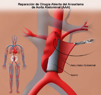 Ilustración de la reparación abierta del aneurisma de aorta abdominal