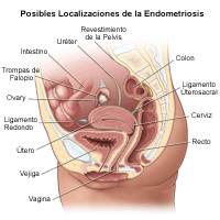 Dibujo que demuestra los lugares donde es posible encontrar endometriosis