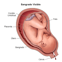 Dibujo que demuestra el sangrado visible durante el embarazo