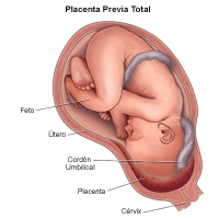 Dibujo que demuestra la placenta previa total
