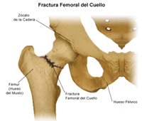 Empalme fracturado de la cadera