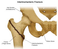 Ilustración de la fractura de intertrocanteric