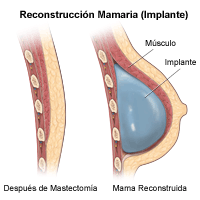 Ilustración de una vista lateral de mama, antes y después de la reconstrucción (Implante)
