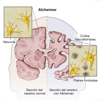 Ilustración que muestra cómo la enfermedad de Alzheimer afecta el cerebro