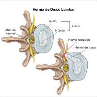 Ilustración de una hernia de disco intervertebral