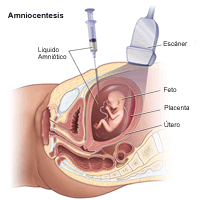 Dibujo que demuestra la amniocentesis