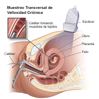 Dibujo que demuestra el muestreo transcervical de la vellosidad coriónica