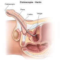 Ilustración de un procedimiento de la cistoscopia en un paciente masculino