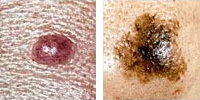 Fotografia comparando un lunar normal y melanoma enseñado asimetría