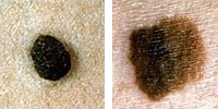 Fotografia comparando un lunar normal y melanoma enseñado color