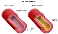 Ilustración de una arteria normal y una afectada