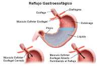 Dibujo que demuestra el reflujo gastroesofagal