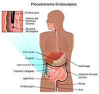 Dibujo que demuestra la colonoscopía