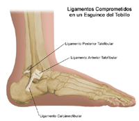 Dibujo que demuestra los tres ligamentos comprometidos en una torcedura o esguince del tobillo