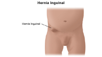 Dibujo que demuestra una hernia inguinal