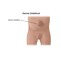 Dibujo que demuestra una hernia umbilical