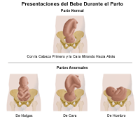 Dibujo que demuestra un parto normal y las presentaciones de parto anormales 