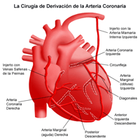 Anatomía del corazón después de la cirugía de derivación de la arteria coronaria, o baipás
