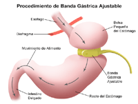 Ilustración de un procedimiento de cirugía restrictiva para adelgazar