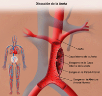 Ilustración de disección aórtica