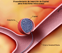 Ilustración del procedimiento de inserción de espiral para aneurisma intracraneal