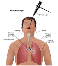 Ilustración de un procedimiento broncoscopia