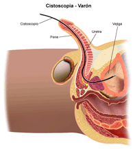 Ilustración de un procedimiento de la cistoscopia en un paciente masculino