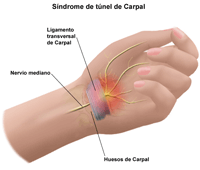Ilustración de la anatomía de la mano del síndrome de túnel carpal