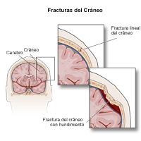 Ilustración de los diferentes tipos de fracturas de cráneo