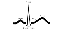 Illustration of  a basic EKG tracing