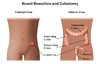 Illustration of  bowel resection and colostomy